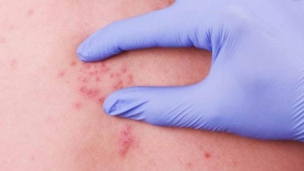 Вот это отдохнули! Опасные болезни, которые можно подцепить за границей Вот это отдохнули! Опасные болезни, которые можно подцепить за границей